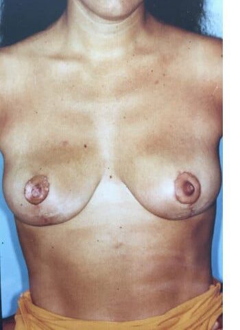 After Image: Breast Lift (Mastopexy) - front