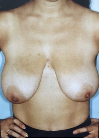 Before Image: Breast Lift (Mastopexy) - front