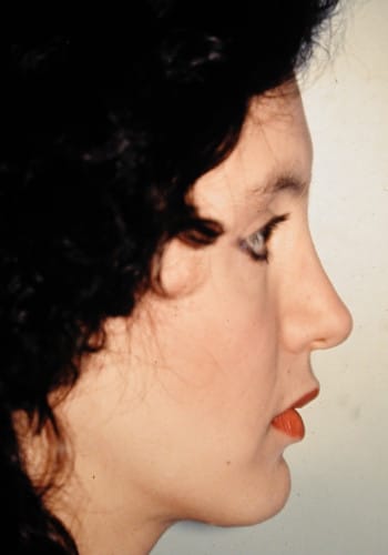 After Image: Rhinoplasty, Genioplasty, Le Fort I - right-side