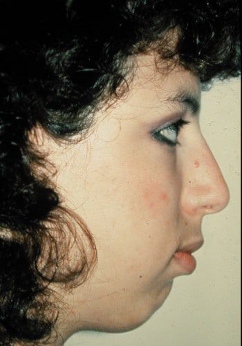 Before Image: Rhinoplasty, Genioplasty, Le Fort I - right-side