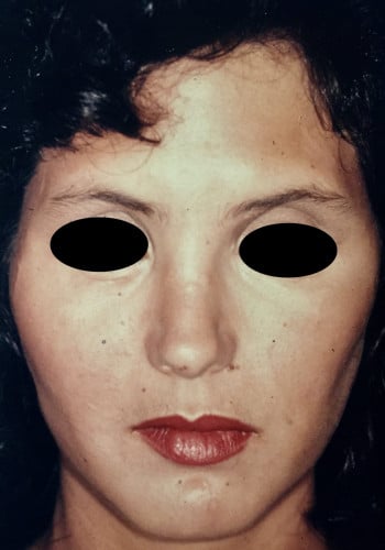 After Image: Rhinoplasty, Genioplasty, Le Fort I - front