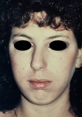 Before Image: Rhinoplasty, Genioplasty, Le Fort I - front