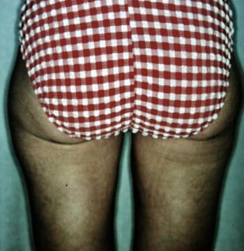 After Image: Liposuction - back