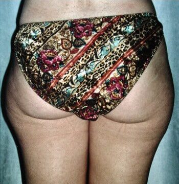 Before Image: Liposuction - back
