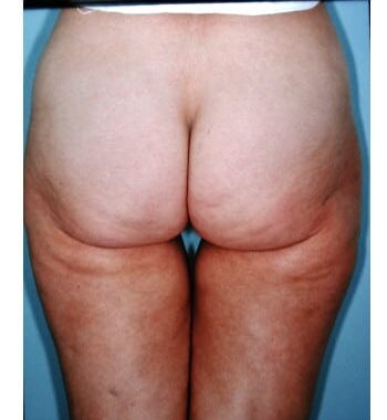 After Image: Liposuction - back