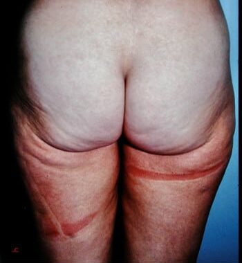 Before Image: Liposuction - back