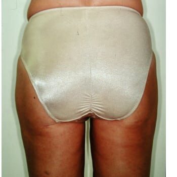 After Image: Liposuction - back
