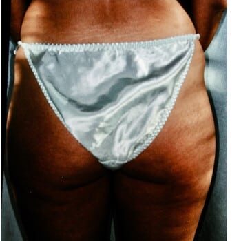 Before Image: Liposuction - back