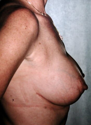 After Image: Mastopexy with Augmentation - right-side