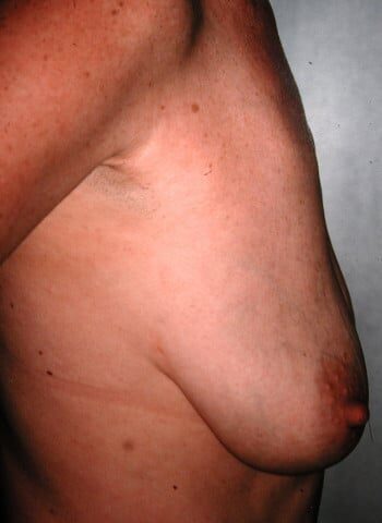 Before Image: Mastopexy with Augmentation - right-side