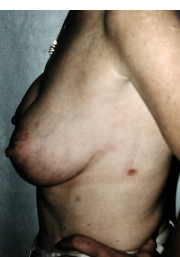 After Image: Mastopexy with Augmentation - left-side