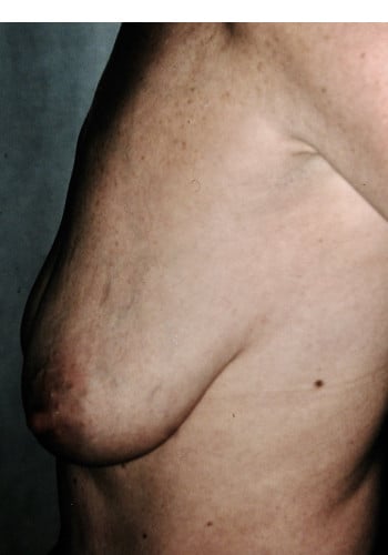 Before Image: Mastopexy with Augmentation - left-side