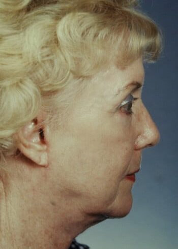 After Image: Facelift, Blepharoplasty - right-side