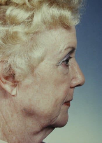 Before Image: Facelift, Blepharoplasty - right-side