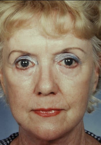 After Image: Facelift, Blepharoplasty - front
