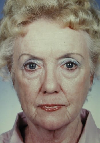 Before Image: Facelift, Blepharoplasty - front