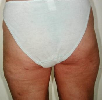 After Image: Liposuction - back