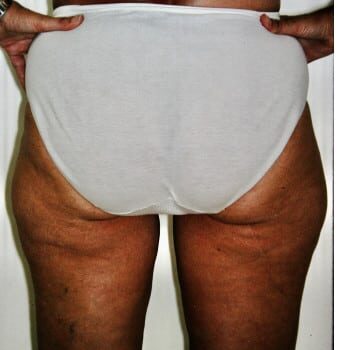 Before Image: Liposuction - back