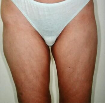 After Image: Liposuction - front