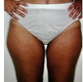 Before Image: Liposuction - front