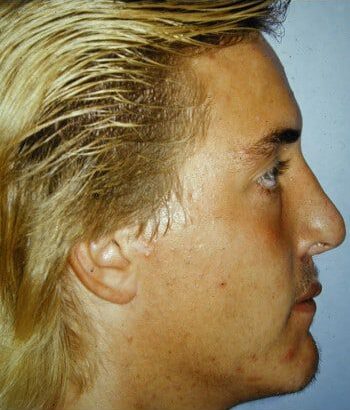 After Image: Cleft Rhinoplasty - right-side
