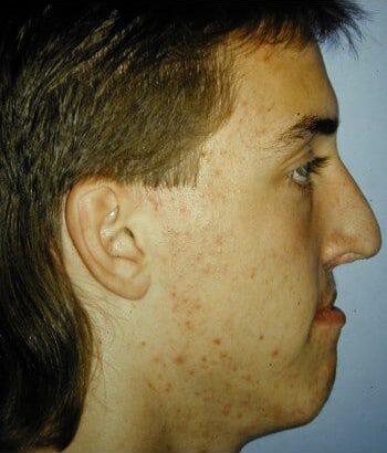 Before Image: Cleft Rhinoplasty - right-side