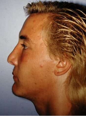 After Image: Cleft Rhinoplasty - left-side