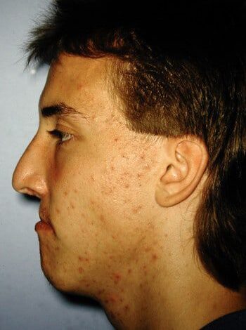 Before Image: Cleft Rhinoplasty - left-side