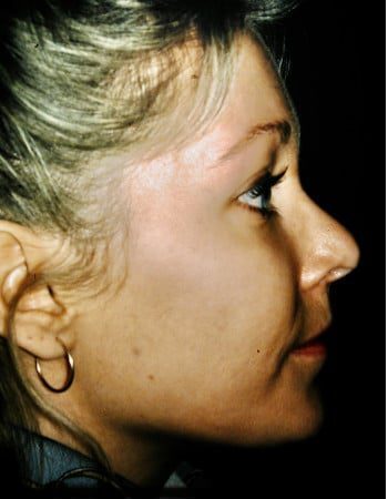 After Image: Rhinoplasty - right-side