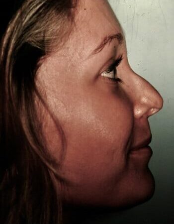 Before Image: Rhinoplasty - right-side