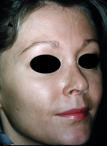 After Image: Rhinoplasty - right-front-oblique