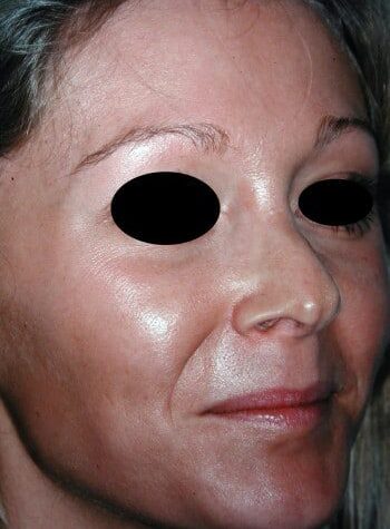 Before Image: Rhinoplasty - right-front-oblique