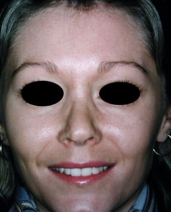 After Image: Rhinoplasty - front