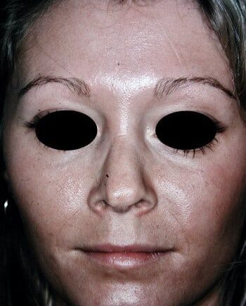 Before Image: Rhinoplasty - front