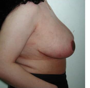 After Image: Breast Reduction - right-side