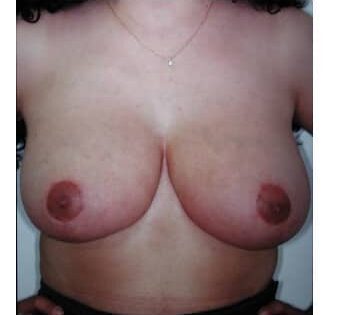 After Image: Breast Reduction - front