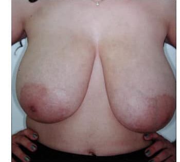 Before Image: Breast Reduction - front