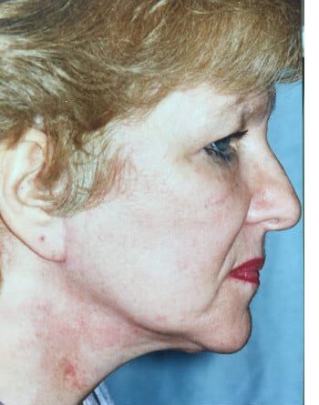 After Image: Facelift - right-side