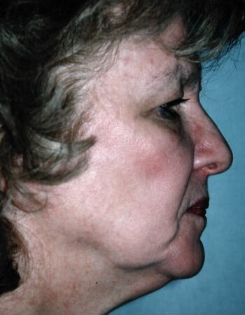 Before Image: Facelift - right-side