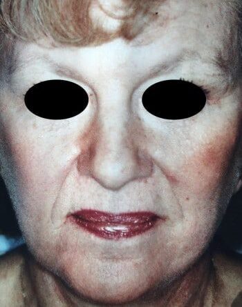 After Image: Facelift - front