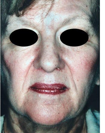 Before Image: Facelift - front