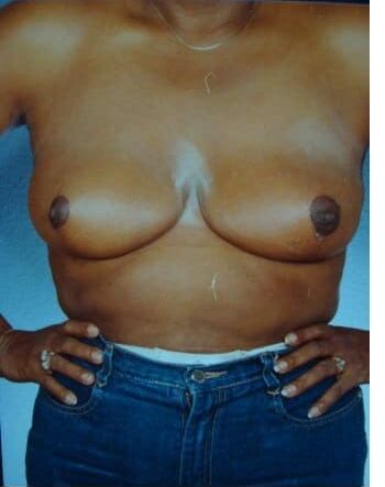 After Image: Breast Reduction - front
