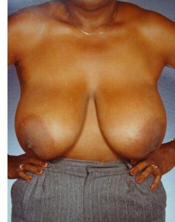 Before Image: Breast Reduction - front