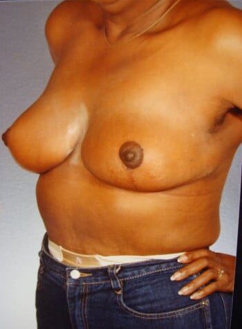 After Image: Breast Reduction - left-front-oblique