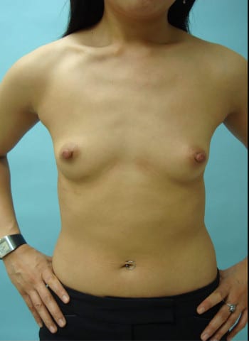 Before Image: Breast Augmentation - front
