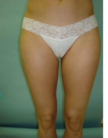 After Image: Liposuction - front