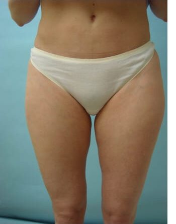 Before Image: Liposuction - front
