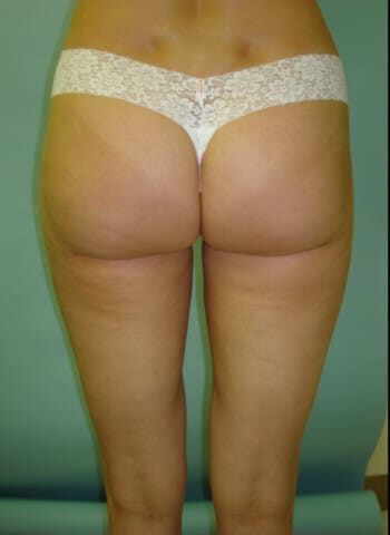 After Image: Liposuction - back