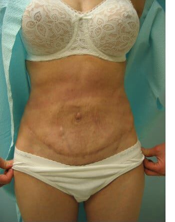 After Image: Abdominoplasty - front