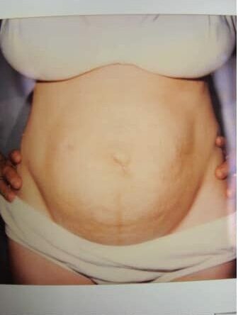 Before Image: Abdominoplasty - front